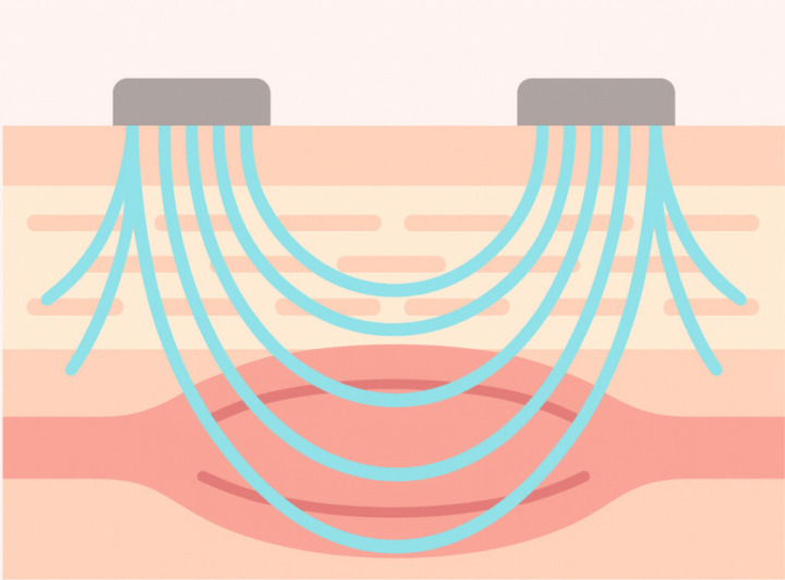 EMS美顔器|表情筋に電気刺激でアプローチ